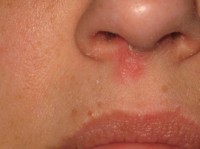cold sores on or in nose